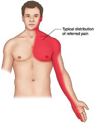 West Hollywood chiropractorreferred pain